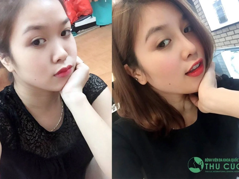 Nâng mũi tại Thẩm mỹ viện Thu Cúc