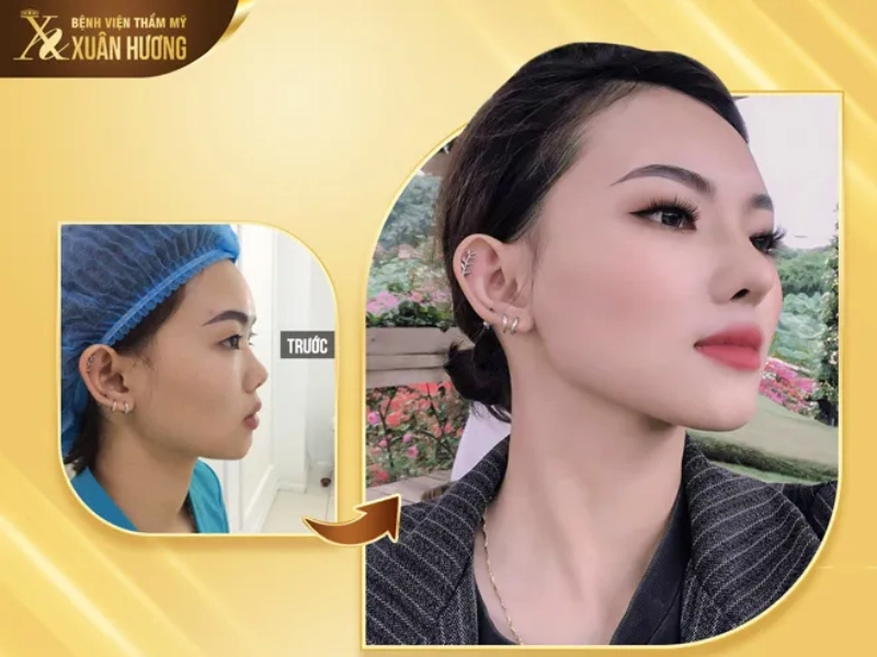 Nâng mũi tại thẩm mỹ viện Xuân Hương