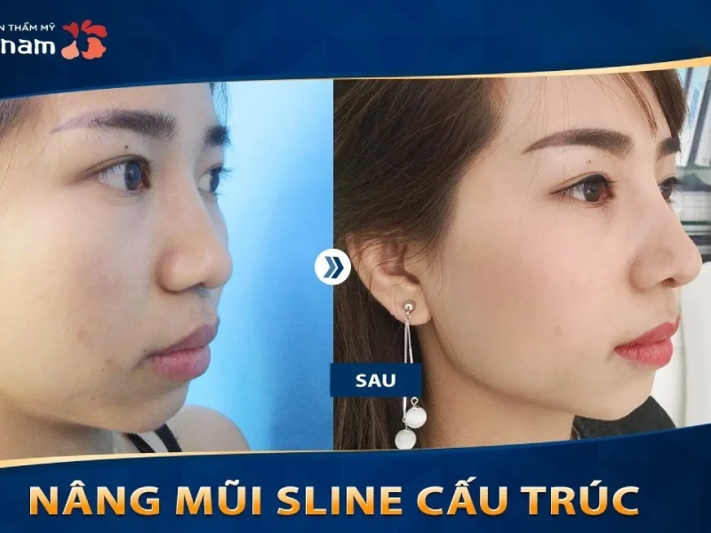 Nâng mũi tại bệnh viện Thẩm mỹ Kangnam