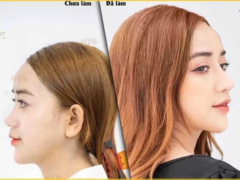 Nâng mũi tại thẩm mỹ viện Tấm