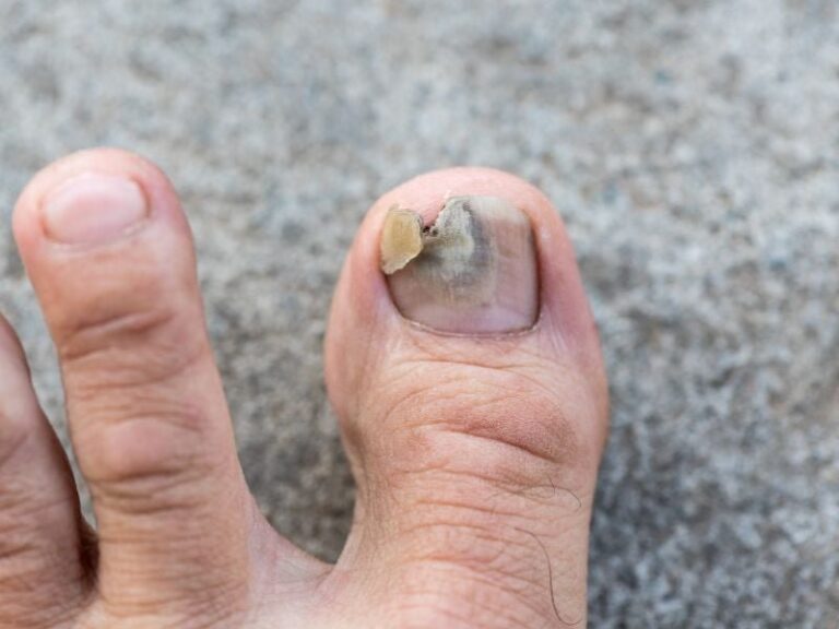 Bí quyết trị nấm móng tay, móng chân hiệu quả ngay tại nhà