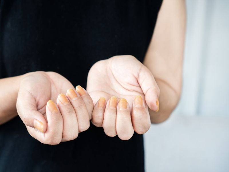 cach-tri-nam-mong-tay-02_e70d50a5335947b4aa9a8b7b5833d300 Nguyên nhân gây nấm móng tay phổ biến