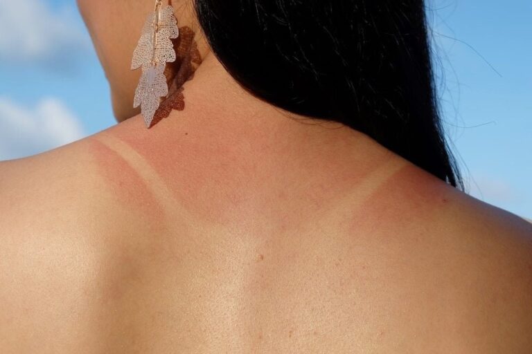 5 cách trị da cháy nắng hiệu quả tại nhà bạn nên biết