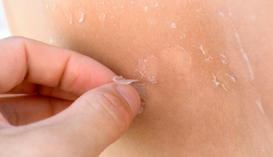 chemical_peel_d6cd52617b2246b59c15d5a575c78a35 lưu ý khi peel da