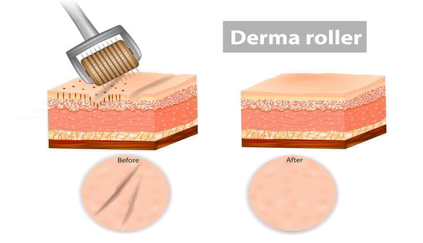cong-nghe-tre-hoa-da-4_d458bb46945d4c5d9b834f27d9ee923a-1 lăn kim trẻ hóa da