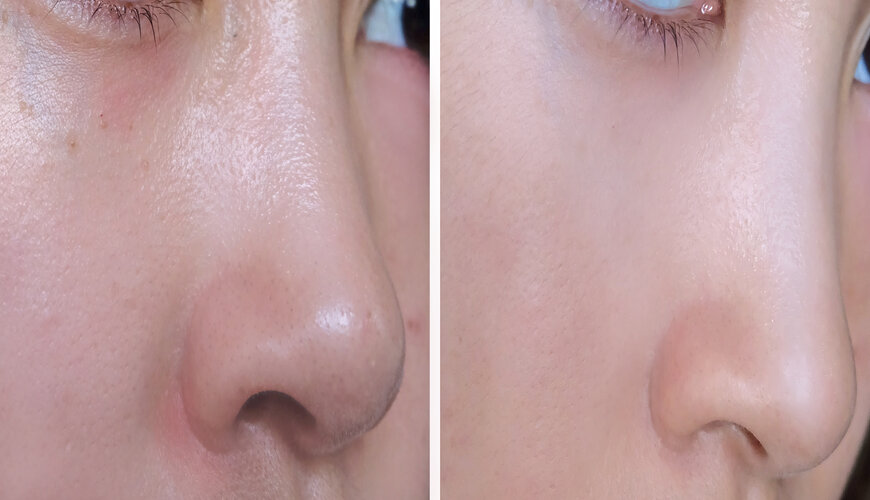 cong_dung_cua_bha_0dcb985346664adba500a665b711e1db công dụng của BHA