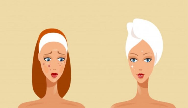 7 bước chăm sóc da mụn phục hồi nhanh chóng hiệu quả