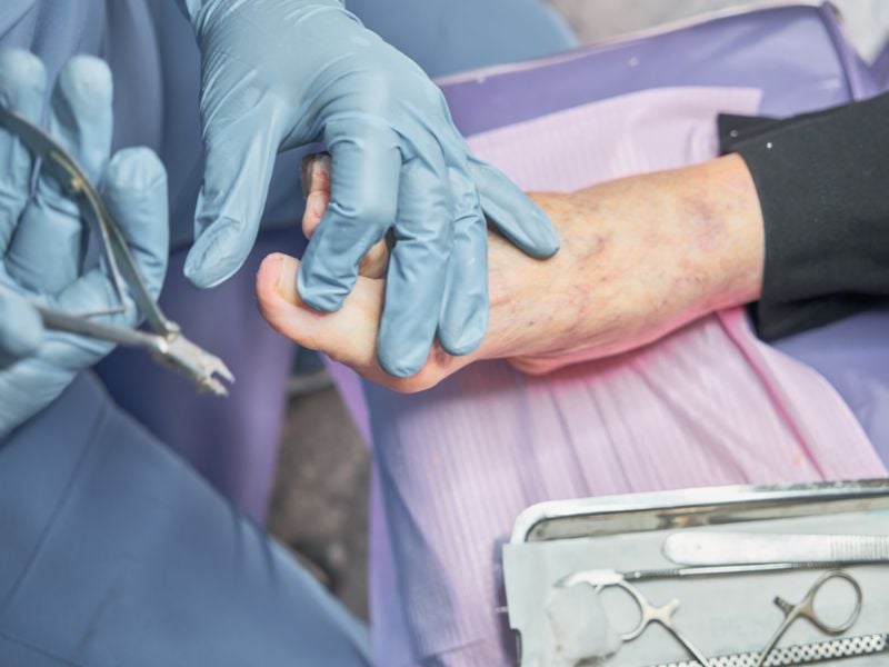 Xử lý móng chân mọc ngược đúng cách