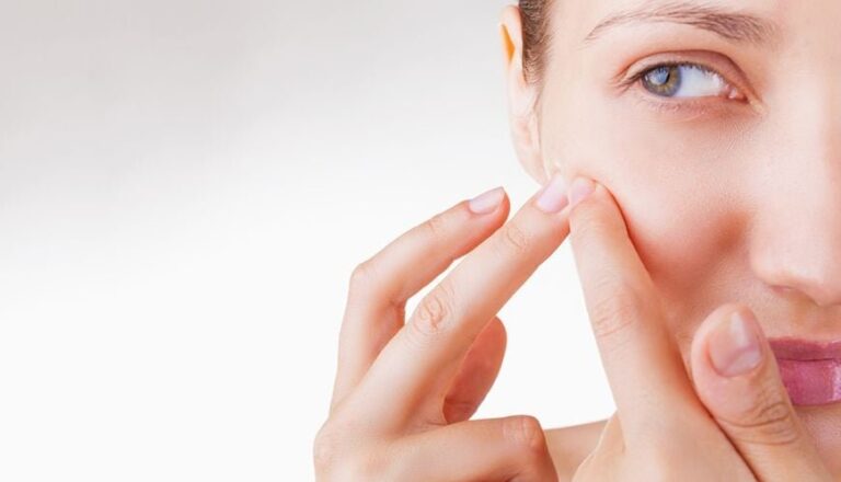 Chăm sóc da ngừa thâm sẹo hiệu quả sau nặn mụn