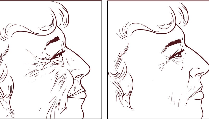 nguyên nhân gây ra nếp nhăn