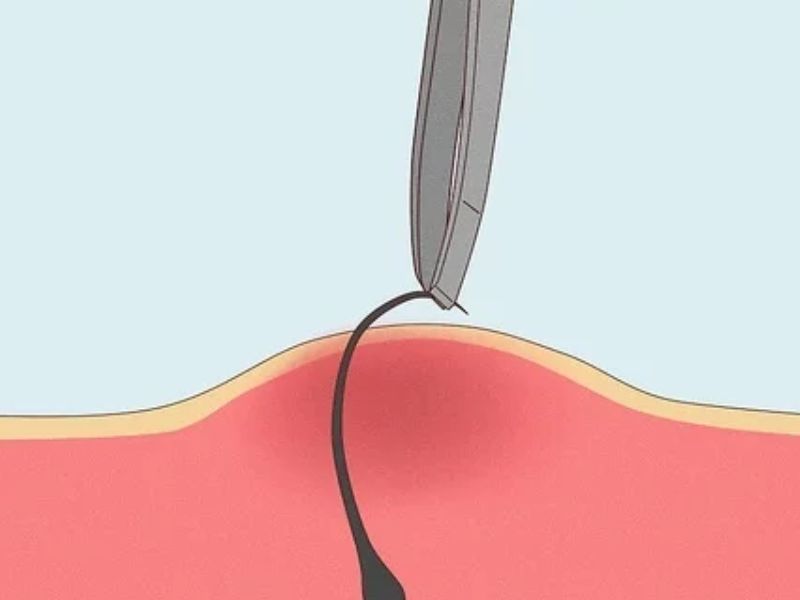 Ưu điểm khi dùng nhíp nhổ lông mọc ngược