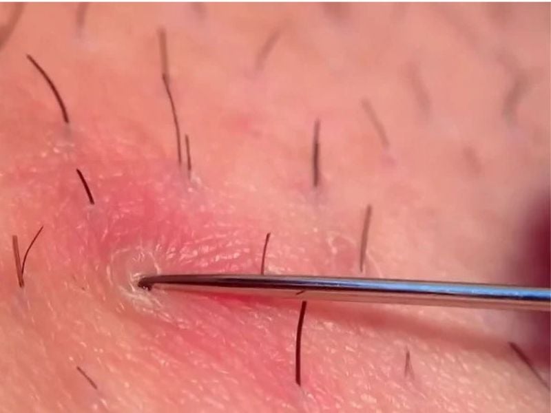 Khi nào lông mọc ngược cần thăm khám bác sĩ?