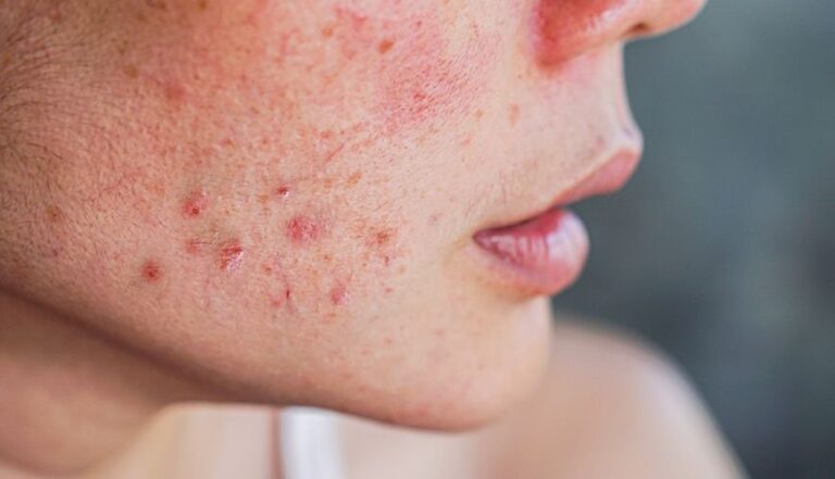 4 cách giảm sưng mụn hiệu quả cho làn da chuẩn đẹp