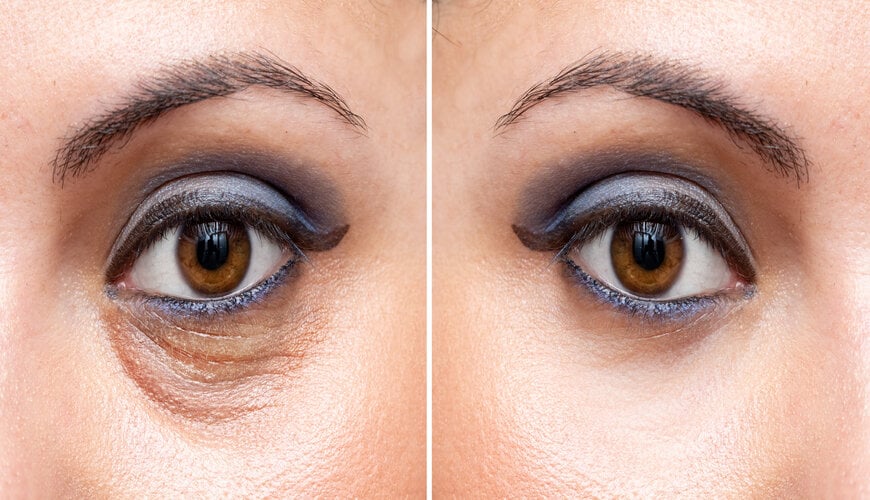 Nếp nhăn mắt lão hóa nằm ở ngay bên dưới của mắt