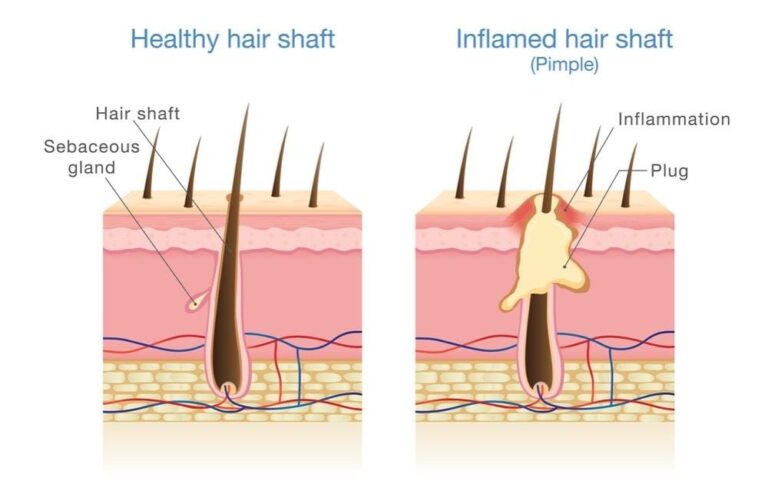 5 cách trị viêm nang lông hiệu quả tại nhà bạn nên biết