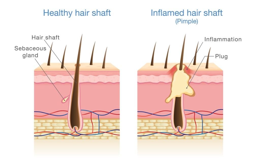Viêm nang lông tích mủ gây khó chịu