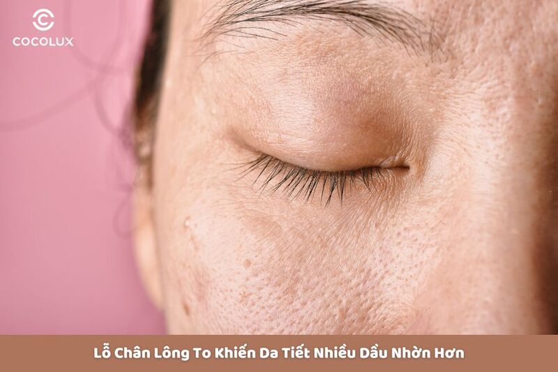 da có nhiều lỗ chân lông khiến dầu ra nhiều hơn