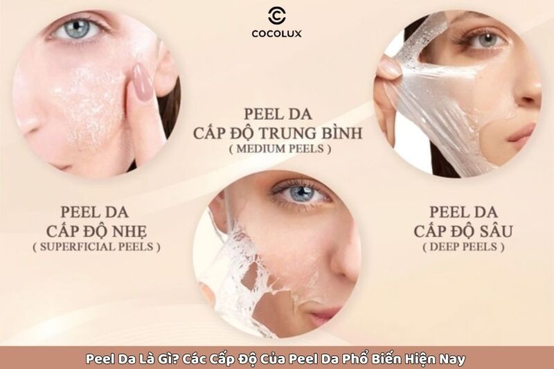 Peel da là gì? Các cấp độ của peel da phổ biến hiện nay 