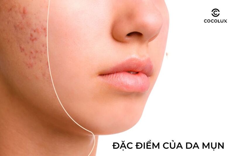 Đặc điểm của da mụn