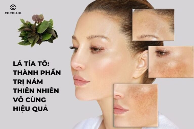 Lá tía tô trị nám hiệu quả với thành phần thiên nhiên