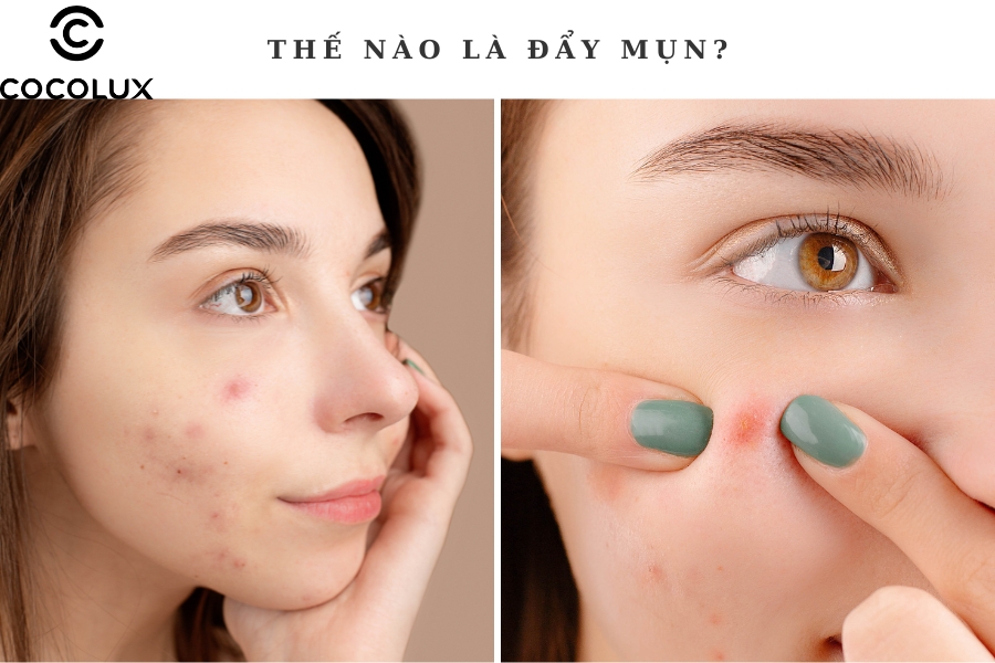 Thế nào là đẩy mụn