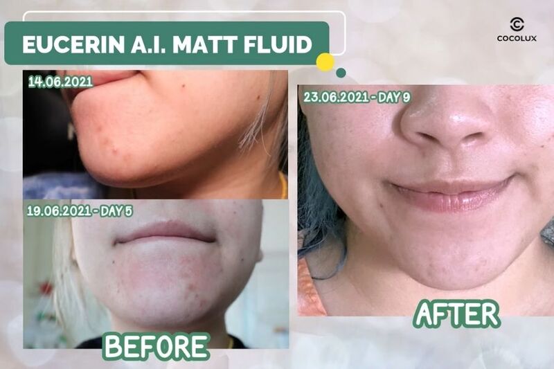 review-kem-duong-eucerin-proacne-solution-ai-matt-fluid-giam-mun-50ml-4 Công dụng của kem dưỡng Eucerin ProAcne Solution A.I Matt Fluid 50ml